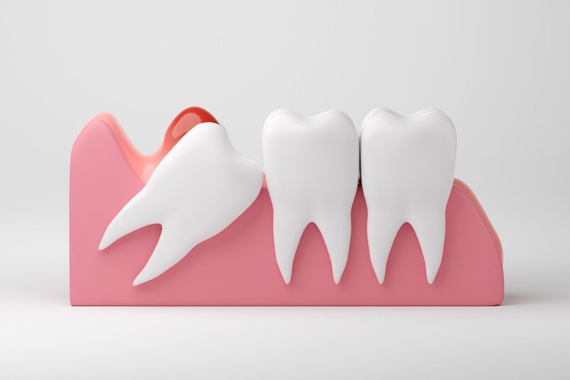What Should You Know About Wisdom Teeth Removal and Recovery?